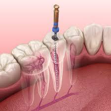 Root Canal Treatment in Budh Vihar