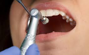 Professional Teeth Cleaning in Budh Vihar